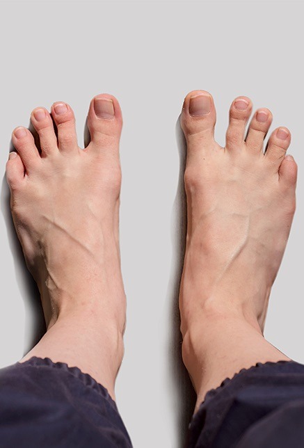 Was ist ein Spreizfuss