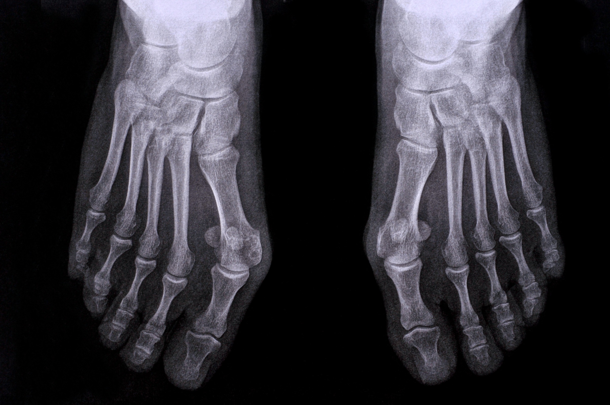 Hallux valgus Roentgenbild