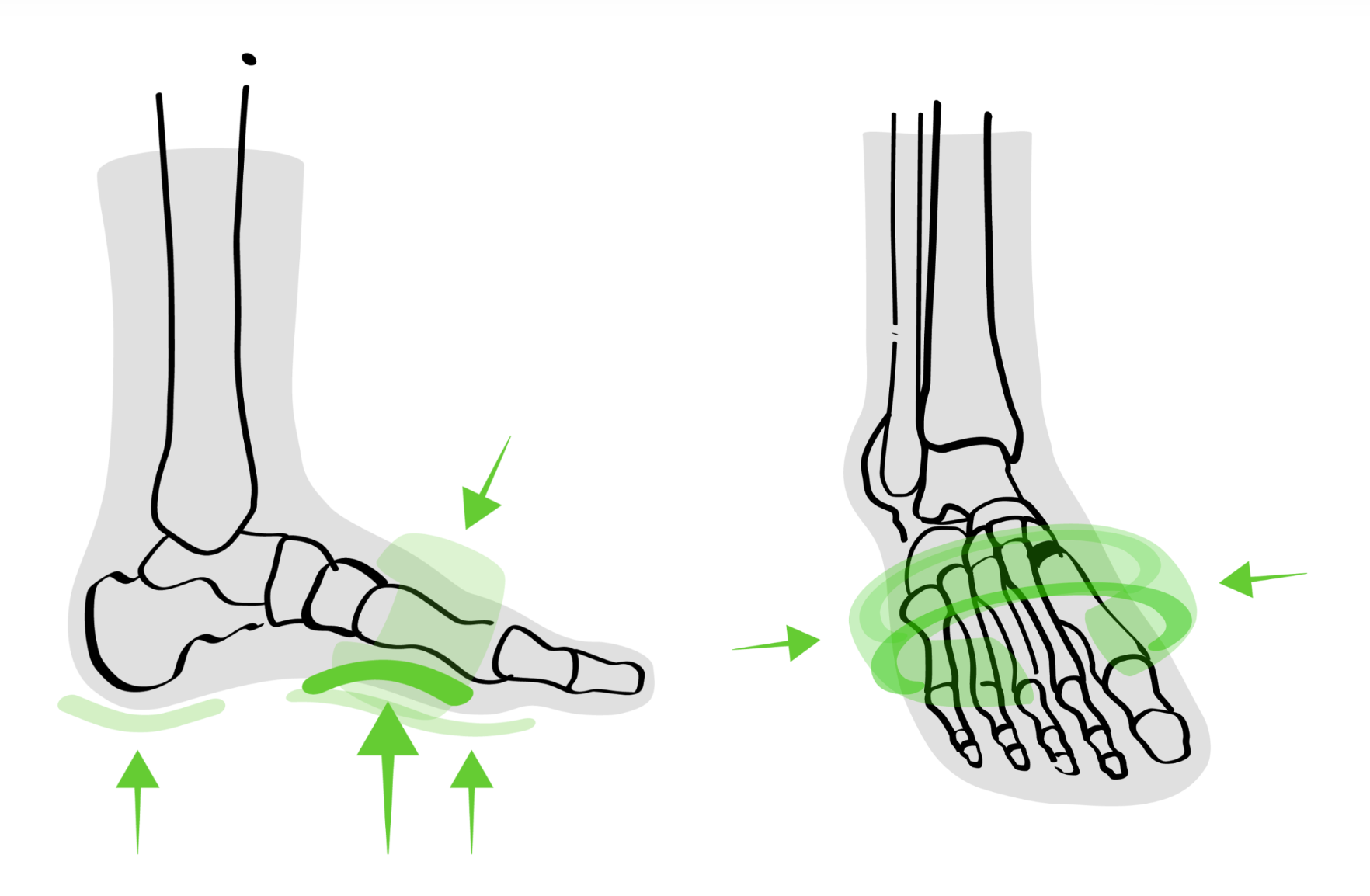 INFINIRI hallux valgus